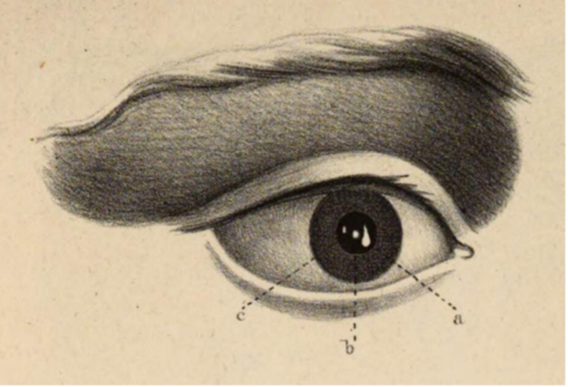 Darstellung der drei Purkinje-Sanson-Bilder.